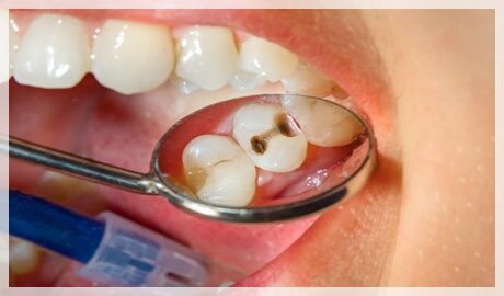 Porselen diş kaplama ne kadar dayanır?